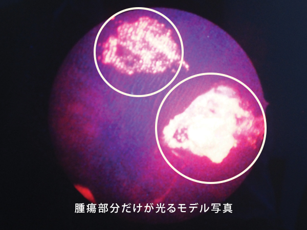 腫瘍部分だけが光るモデル写真