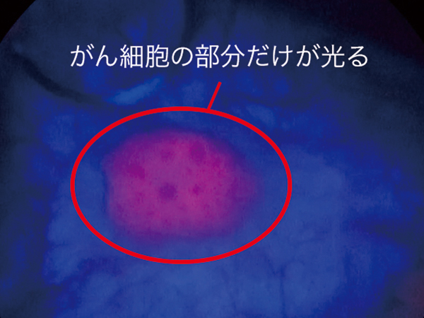 5-ALAによってがん細胞が光っている写真